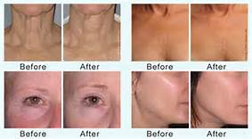 Mesin Korea Microneedle pecahan RF untuk Pore Refining, Jerawat Scar Removal